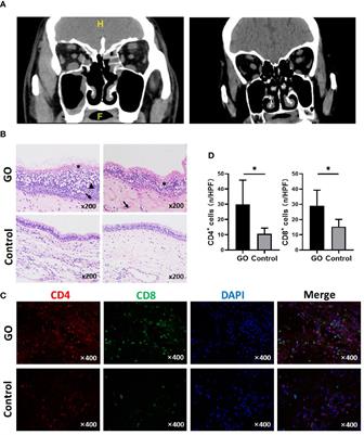 Immunological Features of Paranasal Sinus Mucosa in Patients with Graves’ Orbitopathy